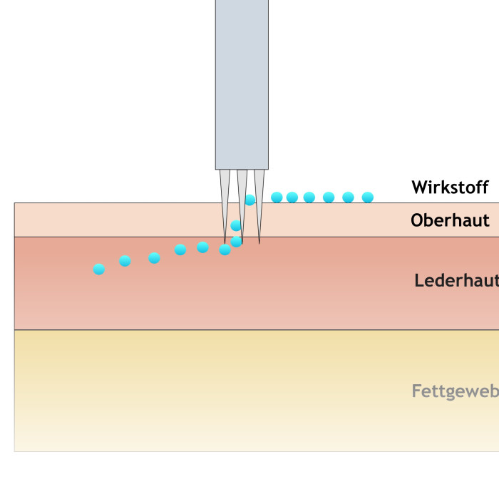 Mikroneedling