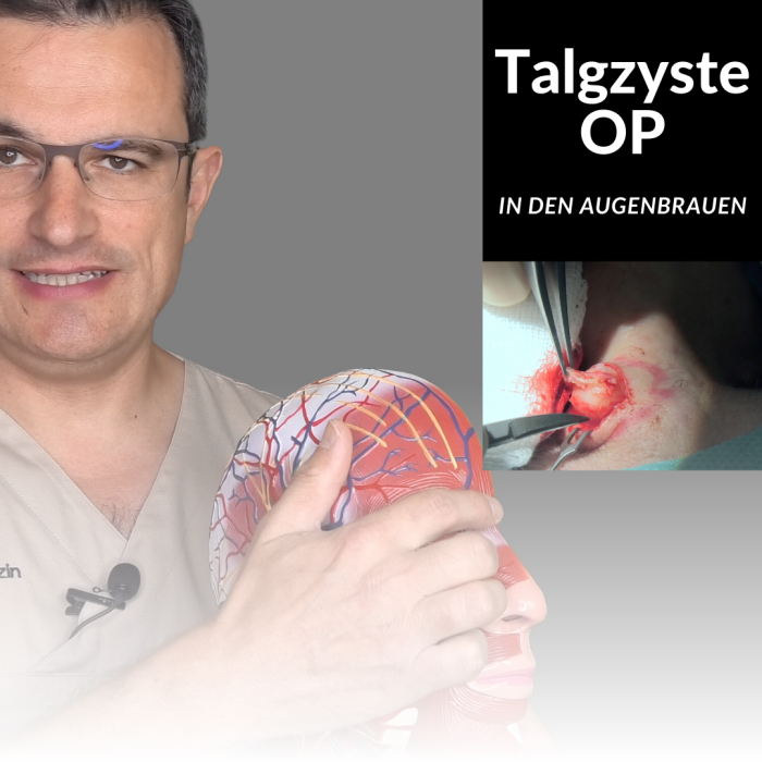 Talgzyste in den Augenbrauen entfernen