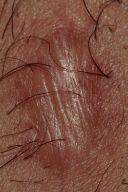 Hypertrophe Narbe