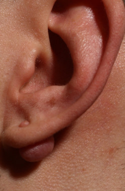 Keloid Narbe