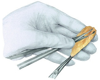 Konventionelle Vorbereitung eines Vollhauttransplantates