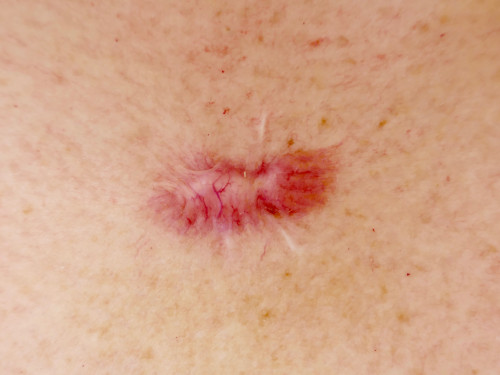 Keloid Narbenwucherung