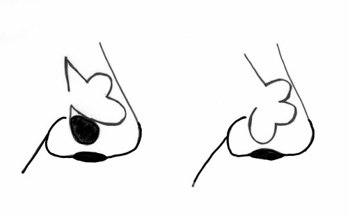 Trilobe Nasenflügel