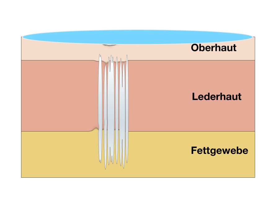 Peeling gegen Aknenarben