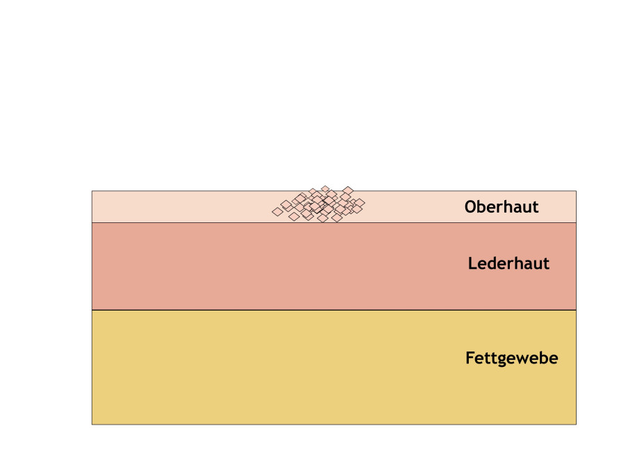 Aktinische Keratose