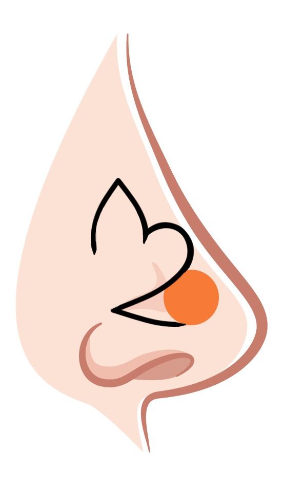 Bilobed flap an der Nase