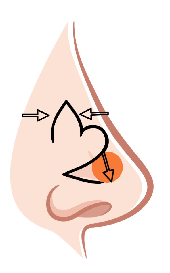 Bilobe flap
