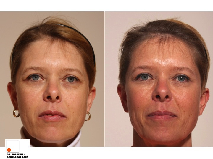Botox Krähenfüße