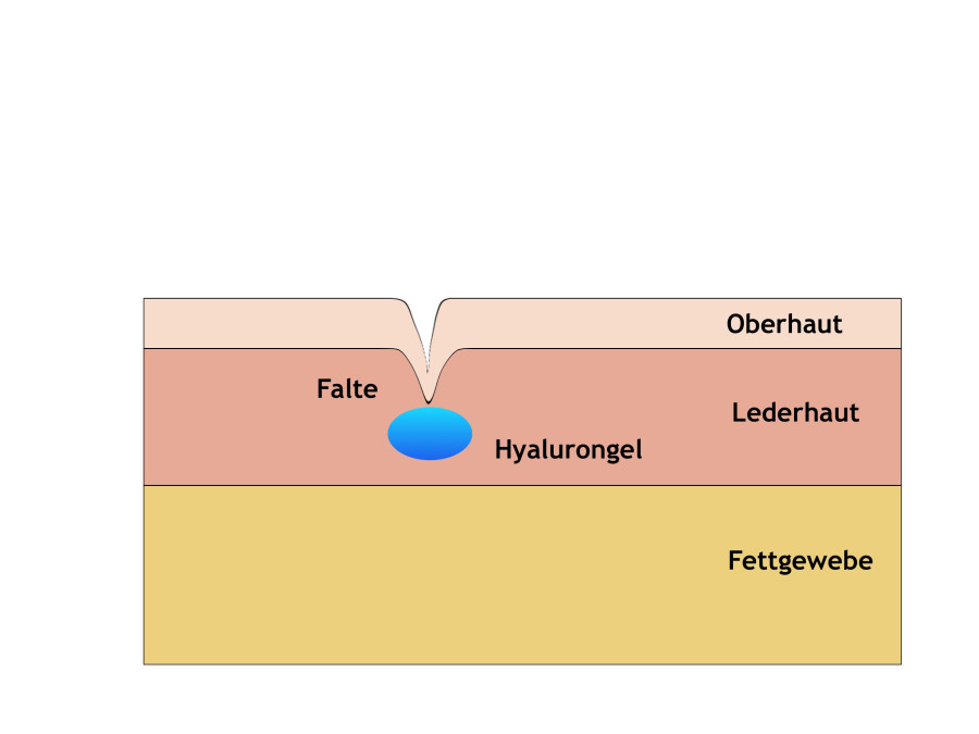 Faltenauffüllung mit Hyalurongel