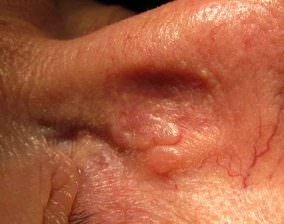 Basaliome- welche Risikofaktoren beeinflussen die Entstehung?