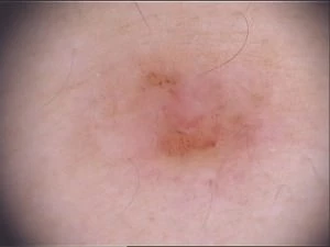 Basaliomentfernung mikrographisch kontrollierte Chirurgie (Mohs)