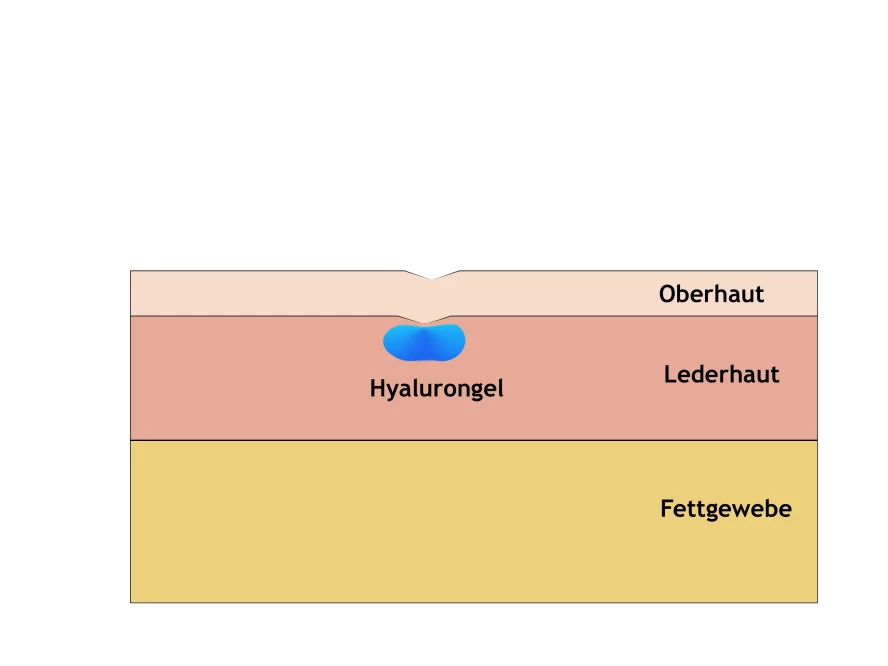 Hyaluron zur Faltenunterspritzung in Mainz