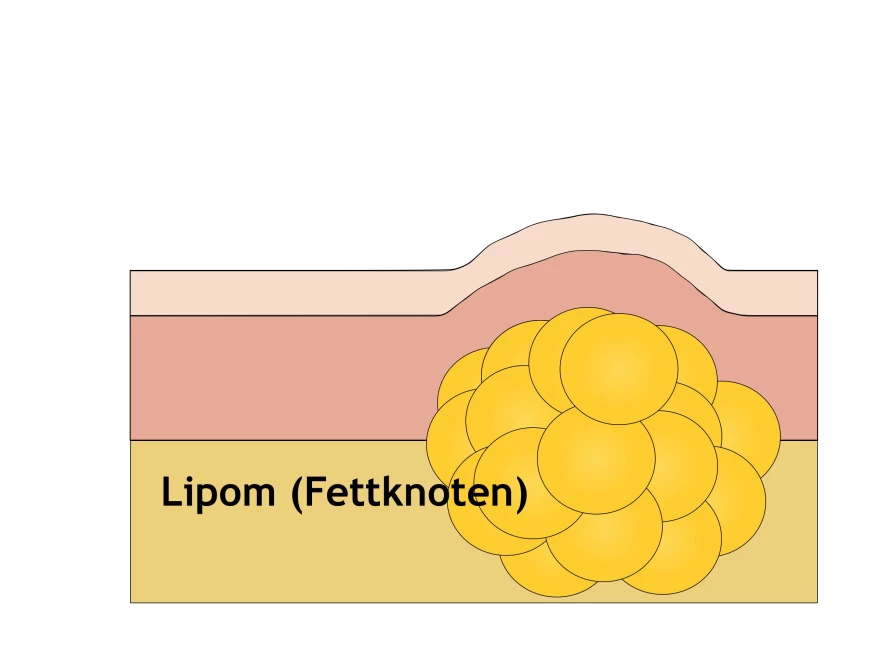 Lipom entfernen in Mainz