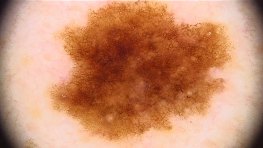 Neues bei der Erkennung von Melanomen