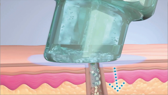 Hydrafacial Behandlung in Mainz