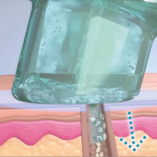 Hydrafacial Behandlung in Mainz Hydrafacial Behandlung in Mainz