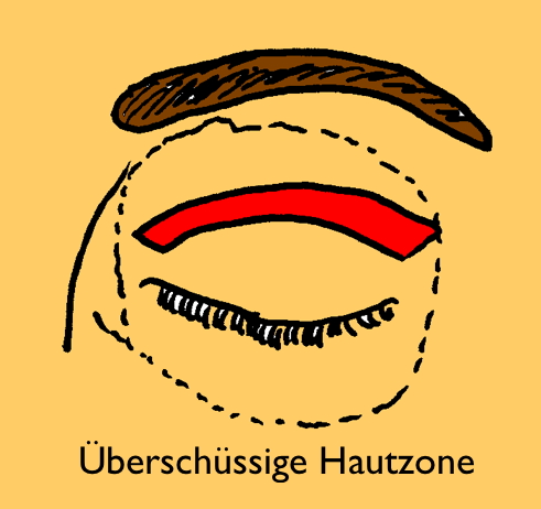 Schlupflid behandeln in Mainz