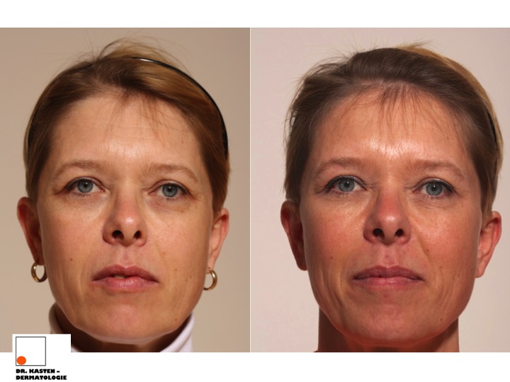 Botox Krähenfüße