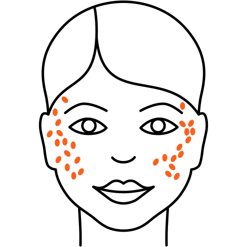 Aknebehandlung (Heilende Medizin)