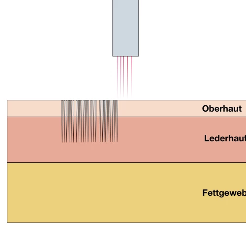 Fraktionierte CO2 Laser Behandlung