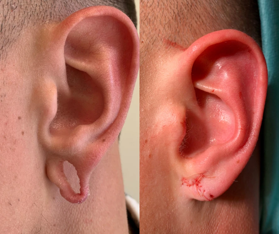 Dempsey Gastfreundschaft Bedeutung gedehnte ohren zunähen wien kosten