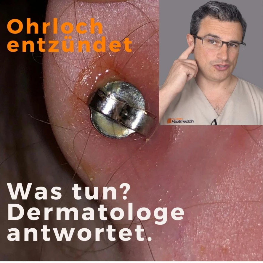 Ohrloch entzündung Entzündete Ohrlöcher