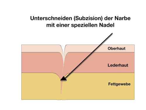 Subzision