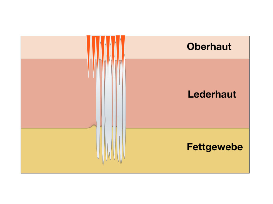 Fraktionierte CO2 Laserabtragung