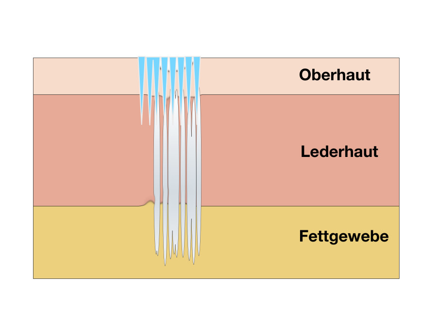 Mikroneedling gegen Aknenarben