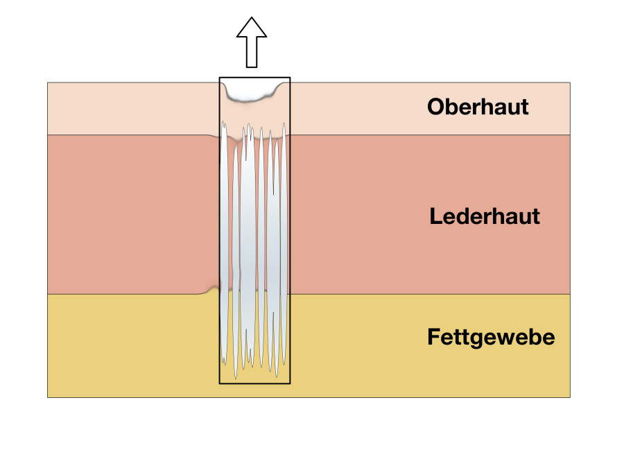 Stanzelevation von Aknenarben