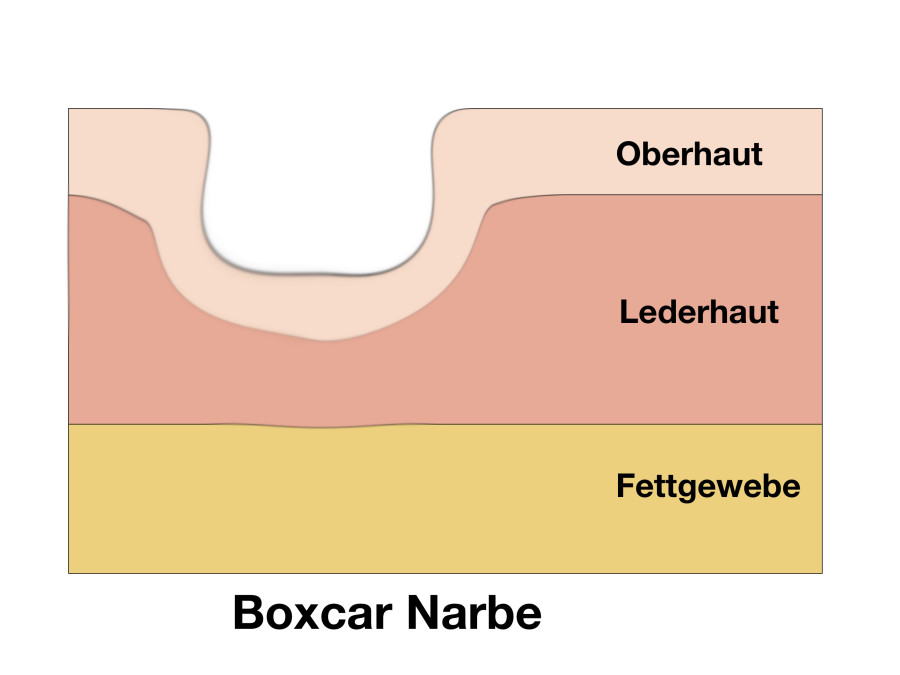 Boxcar Narbe