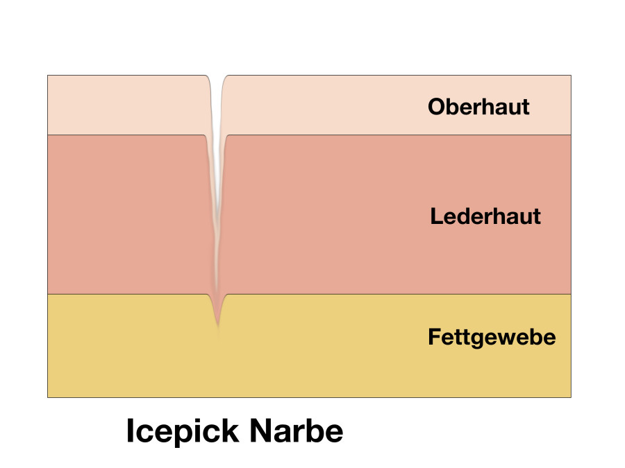 Ice Pick Narben