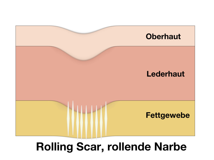 Rolling Scar