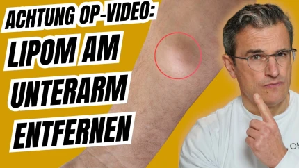  Lipom am Unterarm entfernen: Schonende OP & narbensparende Nahttechnik | Dr. med. Robert Kasten